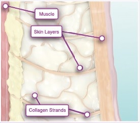 (俗稱)鳳凰電波thermage FLX®–非侵入式緊膚療程原理